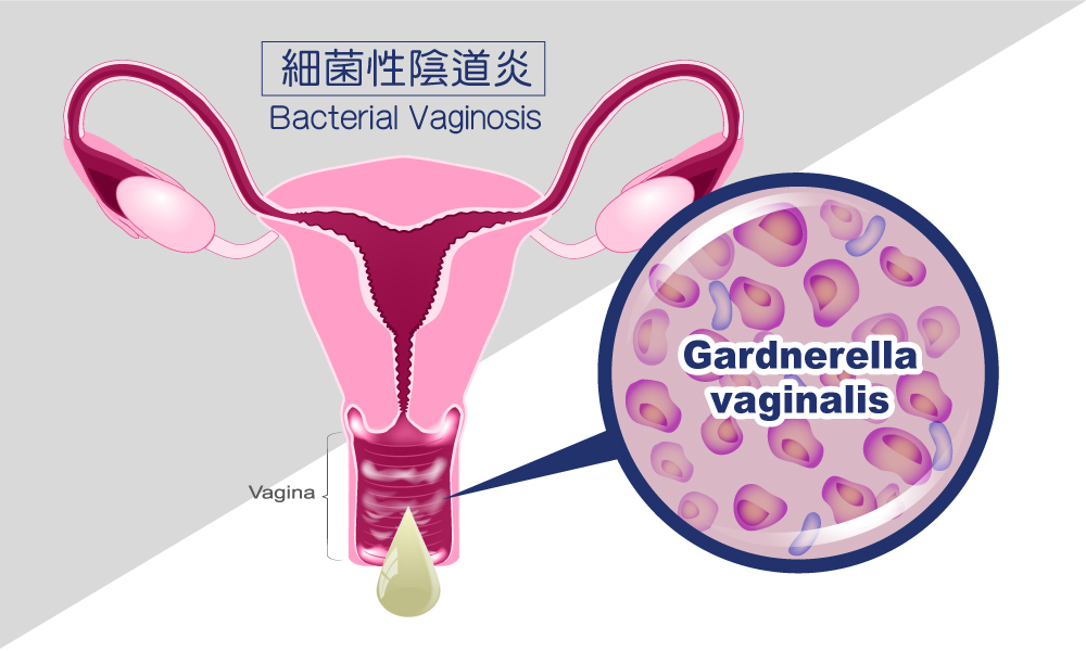 細菌性陰道炎(Bacterial Vaginosis)