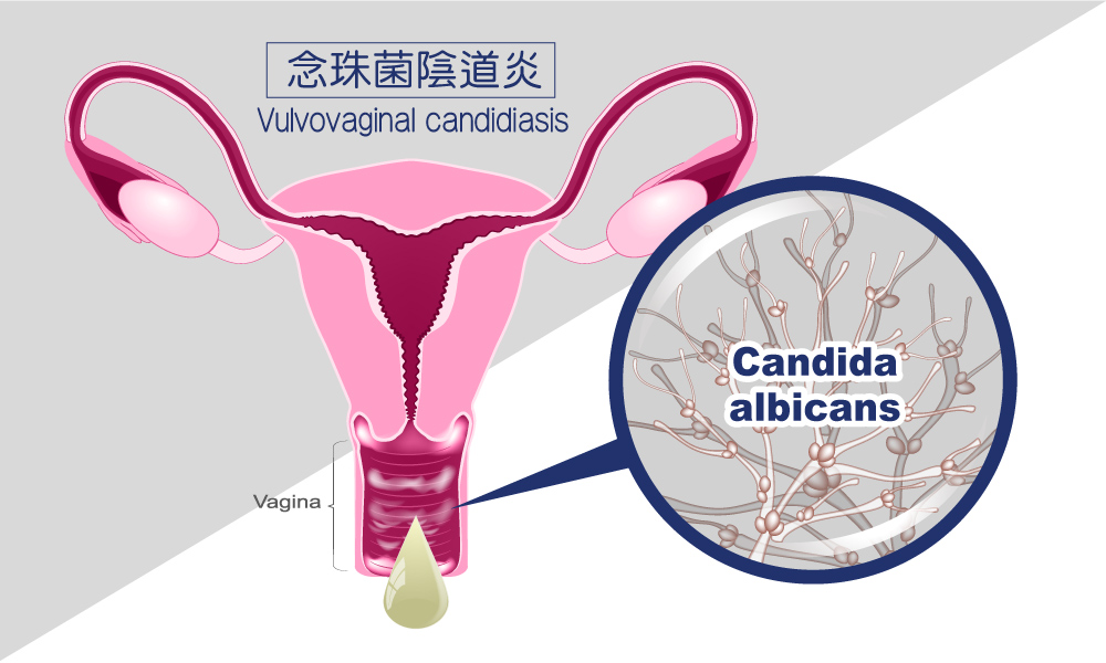 念珠菌陰道炎(Vulvovaginal candidiasis)